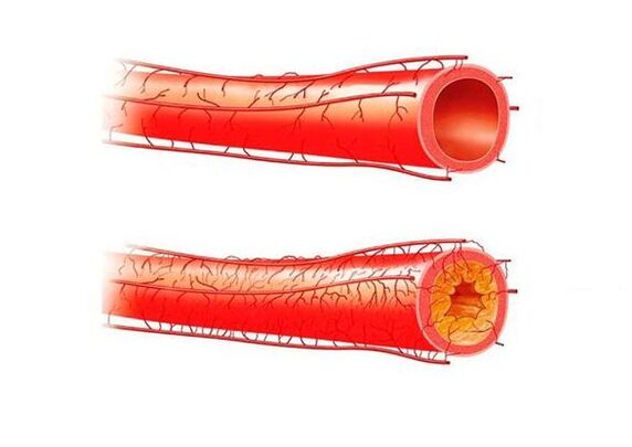 problems with potency caused by blood vessels